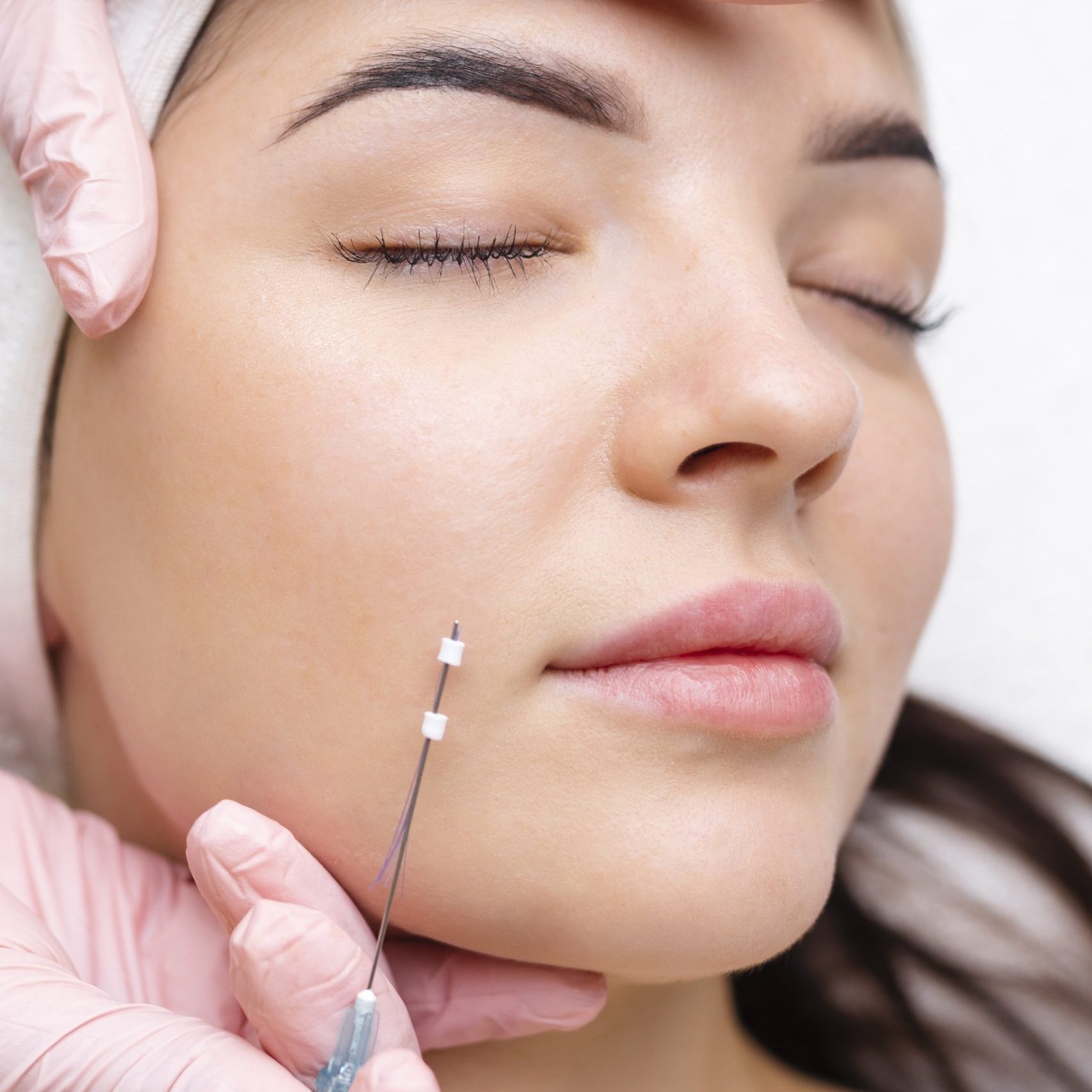 Face lifting PDO Suture operation. innovative technique of New thread lift, cosmetologist preparing to do procedure to