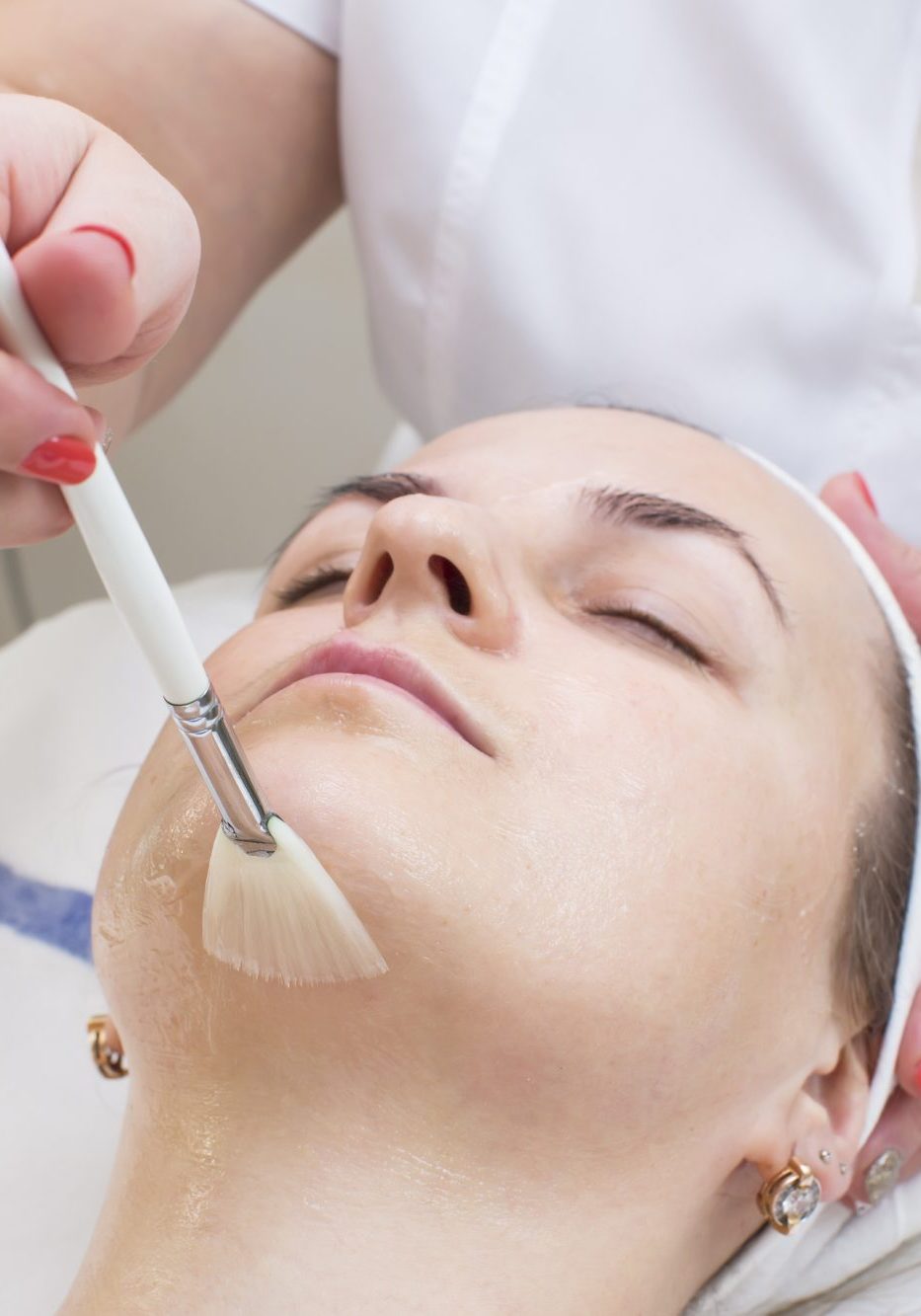 A chemical peel is a technique used to improve and smooth the texture of the skin. Facial skin is mostly treated, and scarring and pigmentations can be improved. Chemical peels are intended to remove the outermost layers of the skin which leave your skin looking fresh and glowing
