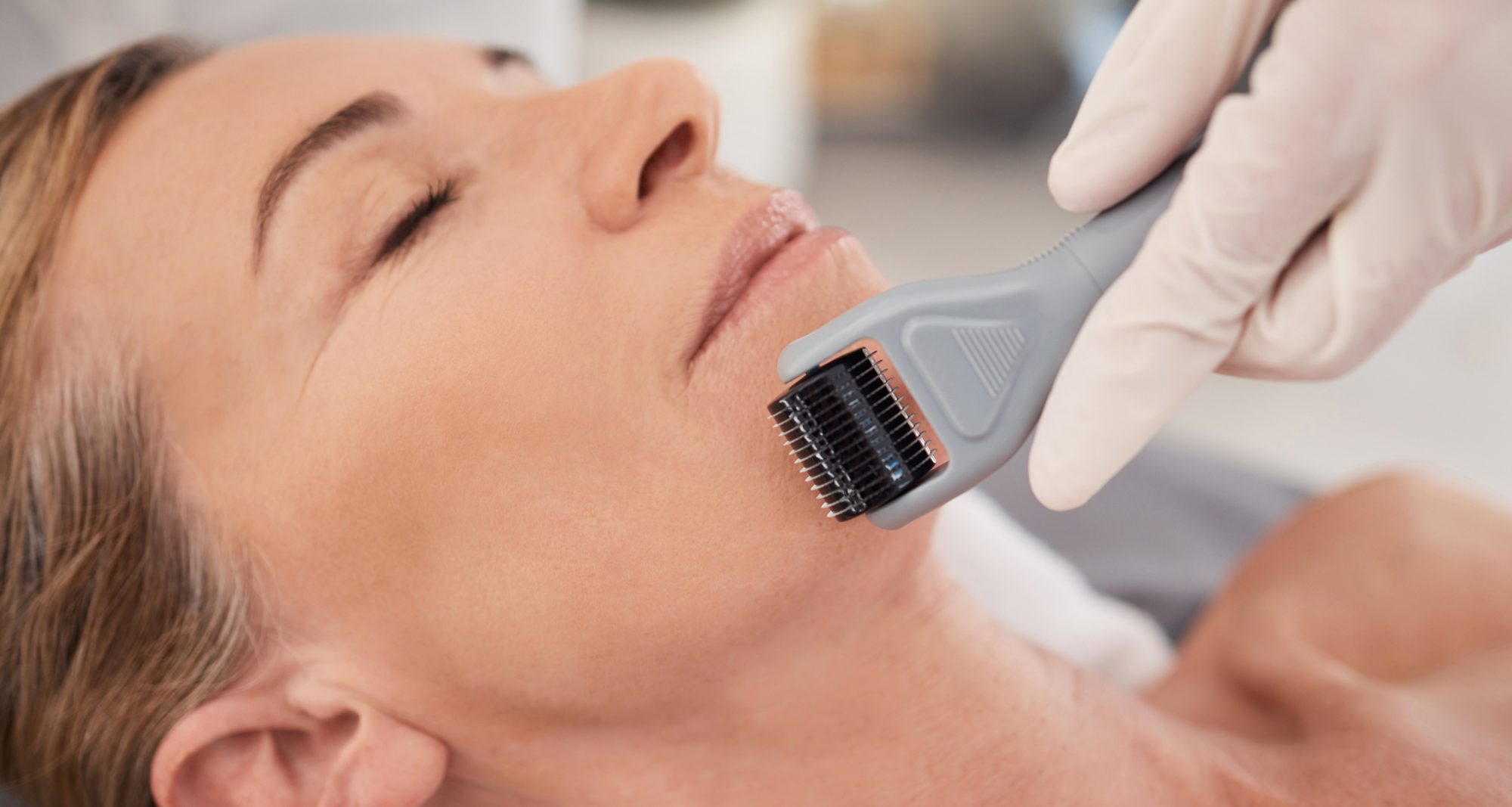 This treatment is wonderful for smoothing out the skin. Closeup shot of a mature woman enjoying a micro-needling treatment at a spa