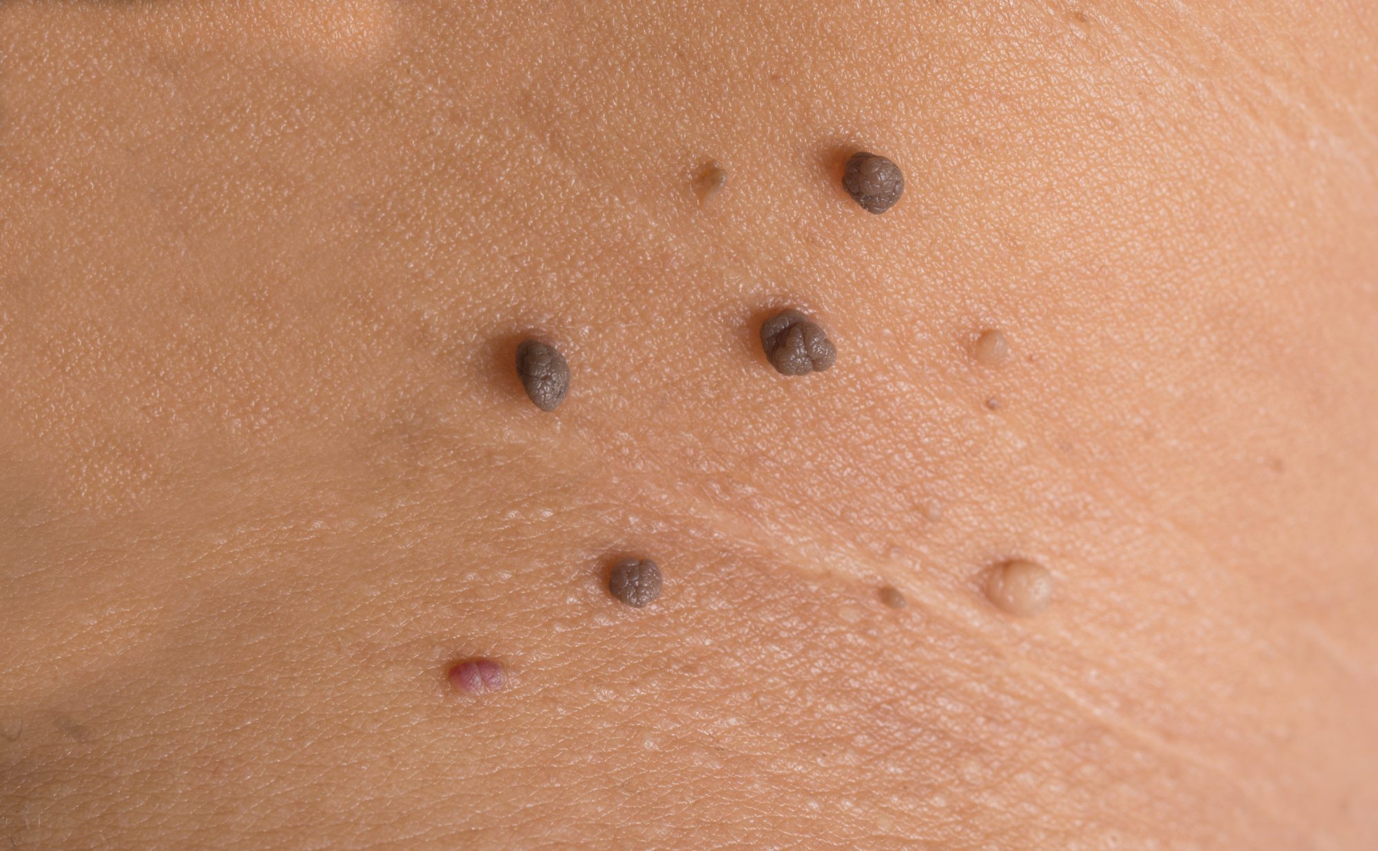 Skin of a woman with moles close up.